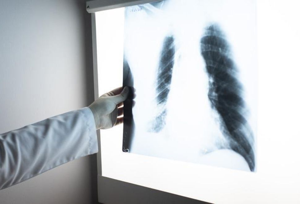 Dünyada Erkeklerde En Sık ‘Akciğer’, Kadınlarda da ‘Meme Kanseri’ Görülüyor